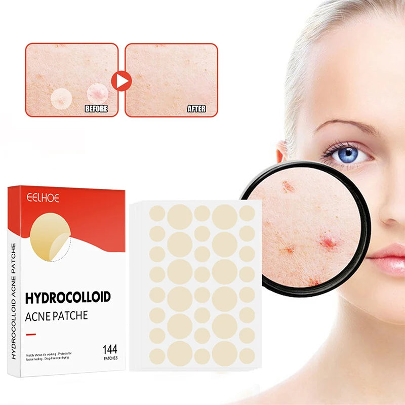 144pcs/set Face Skin Care Acne Pimple Patch 2 Sizes Invisible Professional Healing Absorbing Spot Sticker Covering for Men Women ?