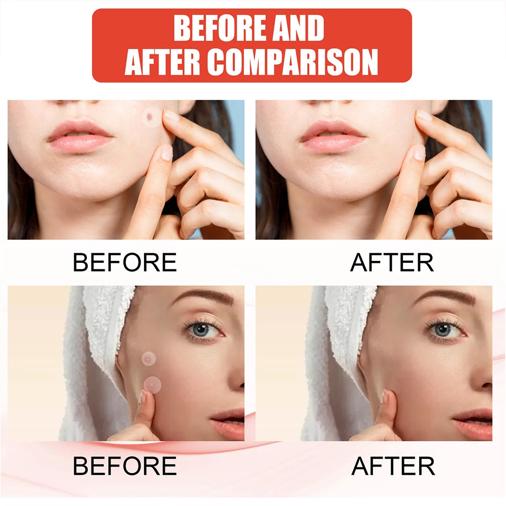 144pcs/set Face Skin Care Acne Pimple Patch 2 Sizes Invisible Professional Healing Absorbing Spot Sticker Covering for Men Women ?